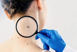 ​У наших клініках можна видалити небажані новоутворення шкіри з гістологічним дослідженням