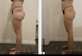 hardware anti-cellulite/lymph drainage/lifting body and face massage