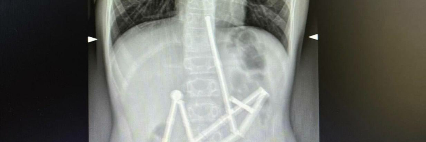 A child swallowed 20 magnets: Okhmatdyt doctors saved her life