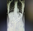 A child swallowed 20 magnets: Okhmatdyt doctors saved her life