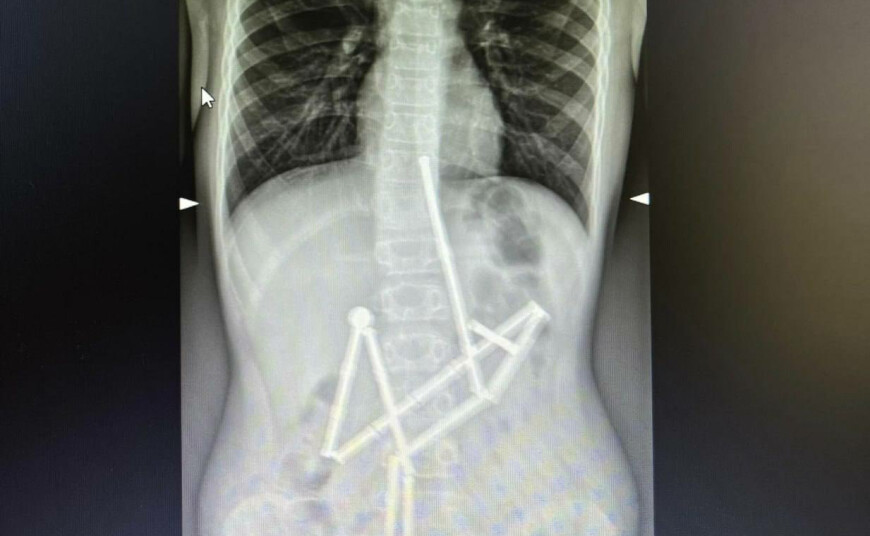 A child swallowed 20 magnets: Okhmatdyt doctors saved her life - 
