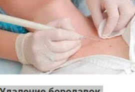 Вилучення бородавок