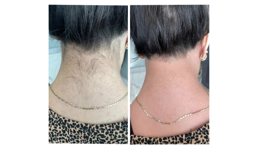 Laser hair removal -