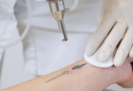 Видалення татуювань